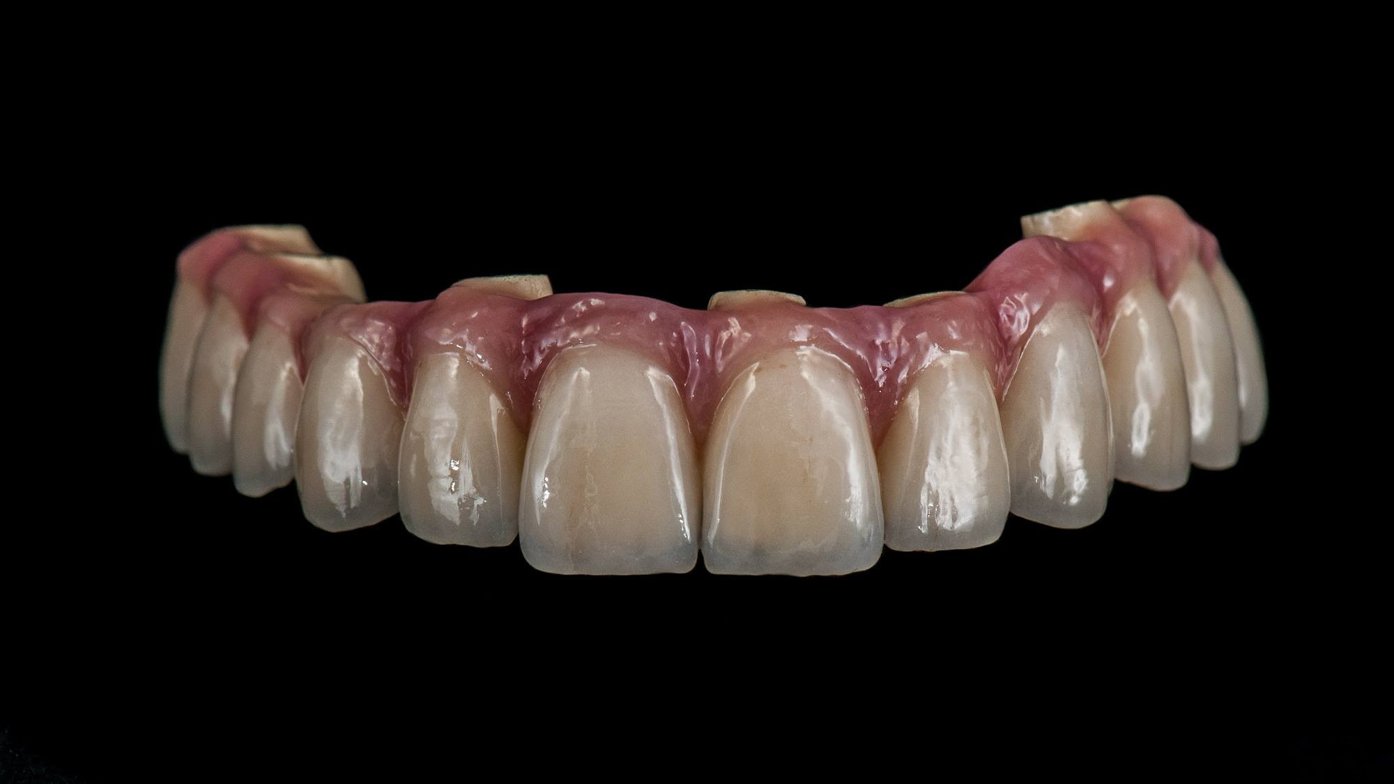 Implant Restorations