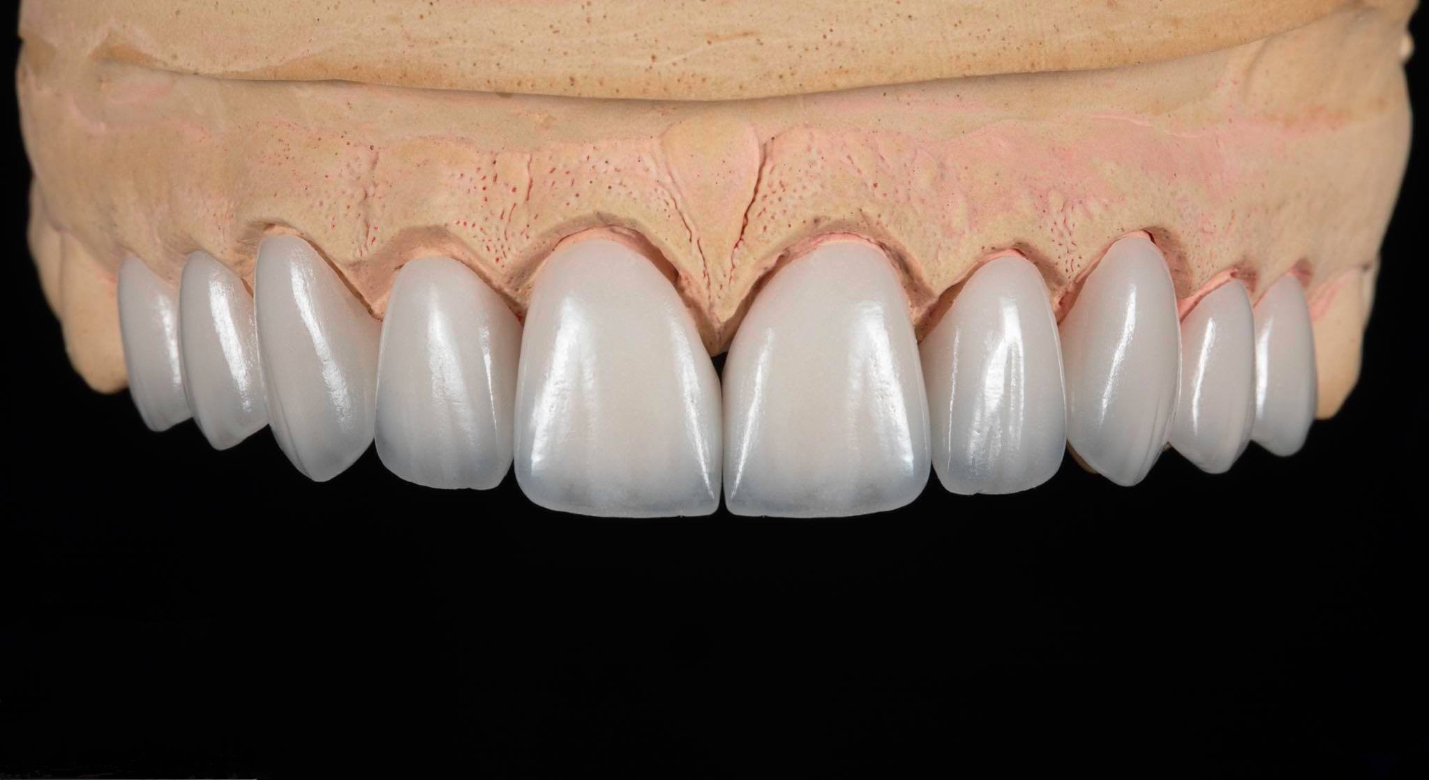 Zirconia Crowns